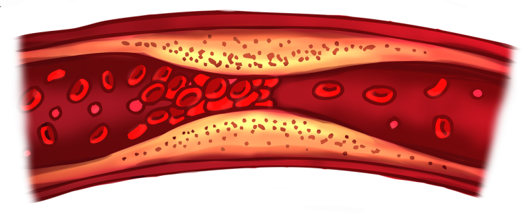 Cholesterol